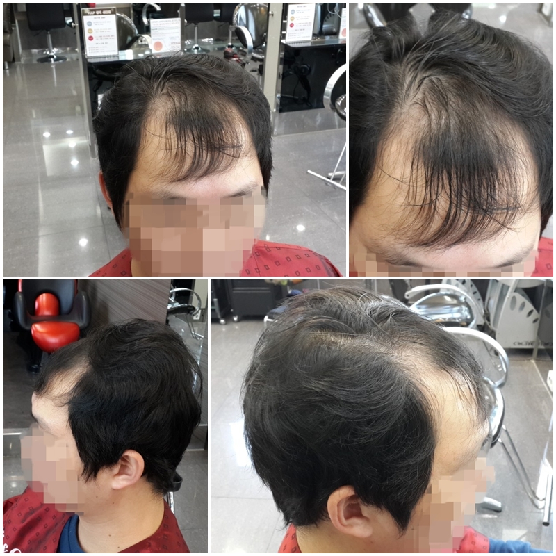 M자 탈모 헤어스타일 : 네이버 블로그