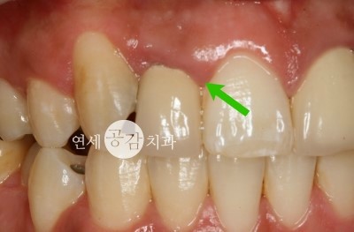 잇몸 고름주머니 신경치료 과정 : 네이버 블로그