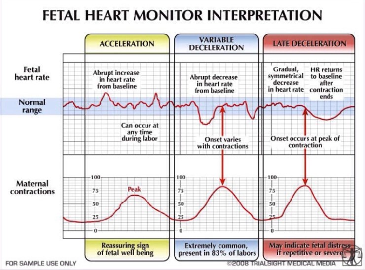 fetal-heart-rate-during-labor
