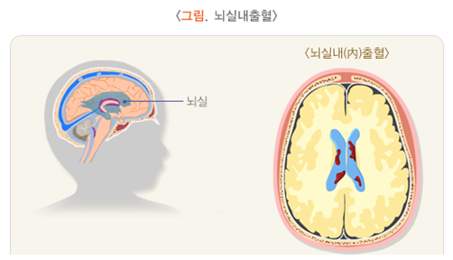 진단명] 뇌실내출혈 (IVH:intraventricular hemorrhage) : 네이버 블로그